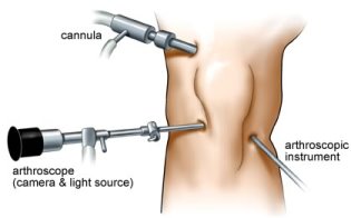 Knee Arthroscopy